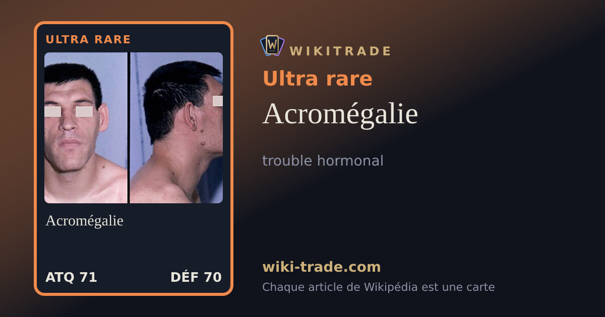 Acromégalie — carte Ultra rare